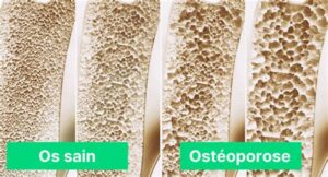 Ostéoporose