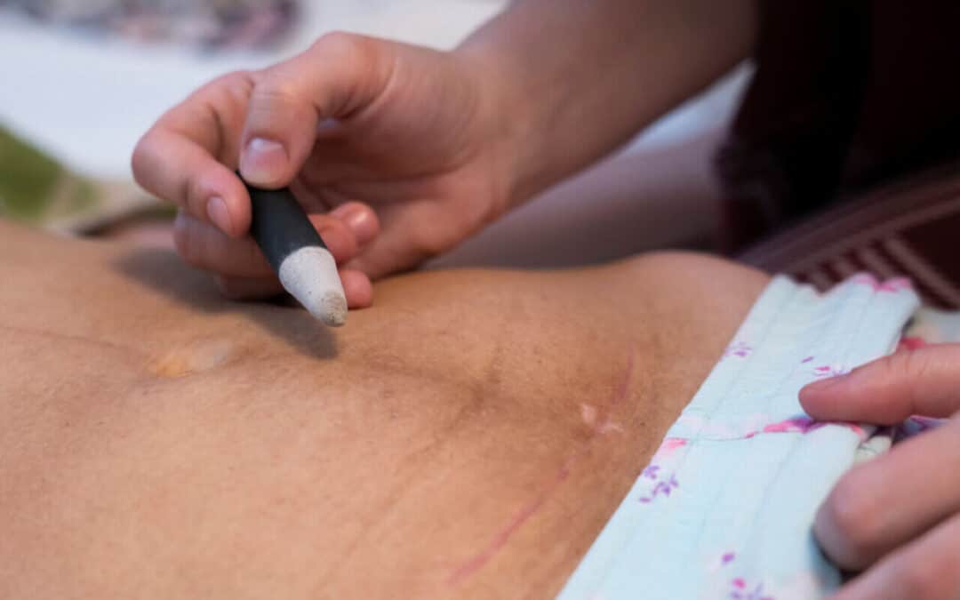 Article sur la moxibustion par Anne-Françoise BAYET