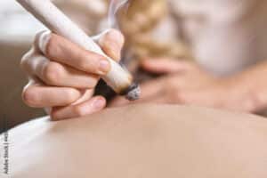 Moxibustion